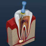 How To Prepare For Root Canal Treatment