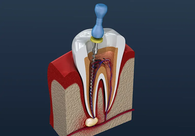 How To Prepare For Root Canal Treatment